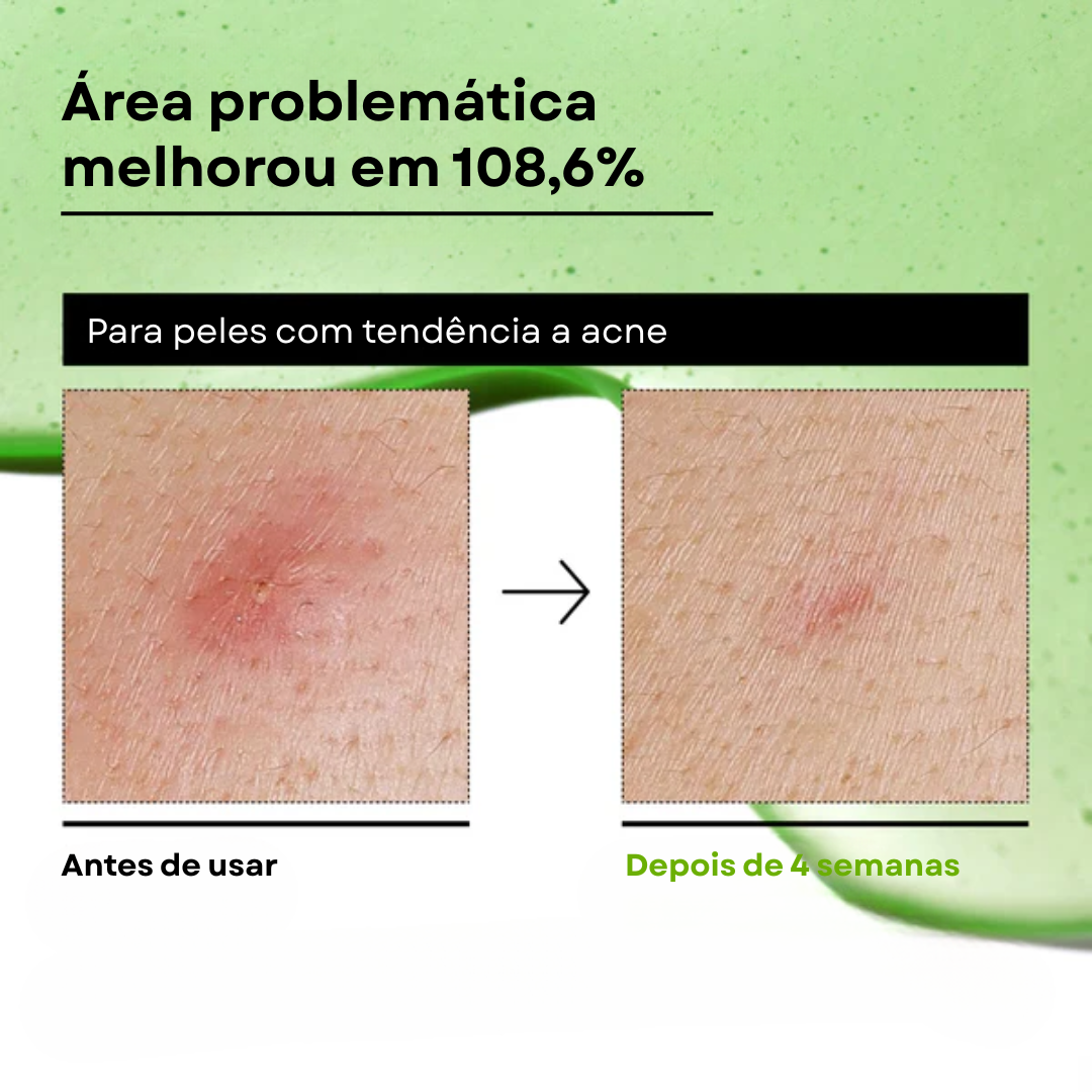 Ácido Azelaico + Centella