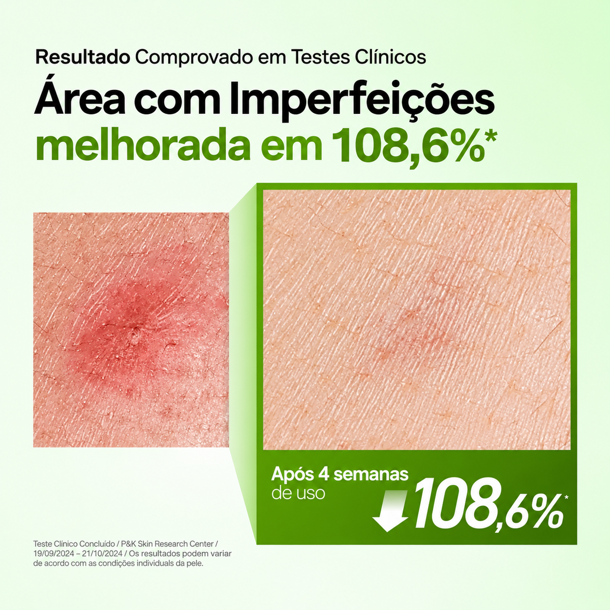 Ácido Azelaico + Centella