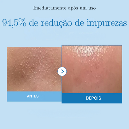 Óleo + LHA + Niacinamida